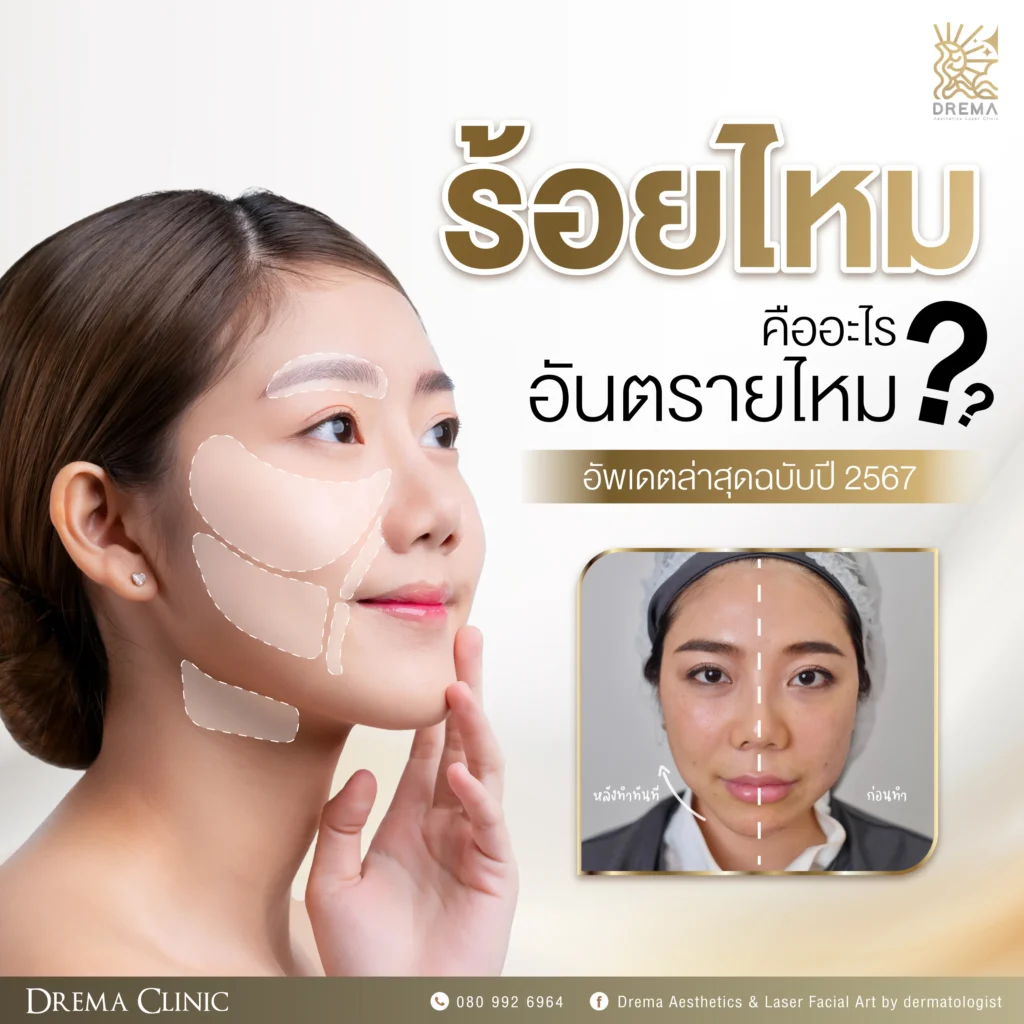 ร้อยไหมคืออะไร อันตรายไหม 2567