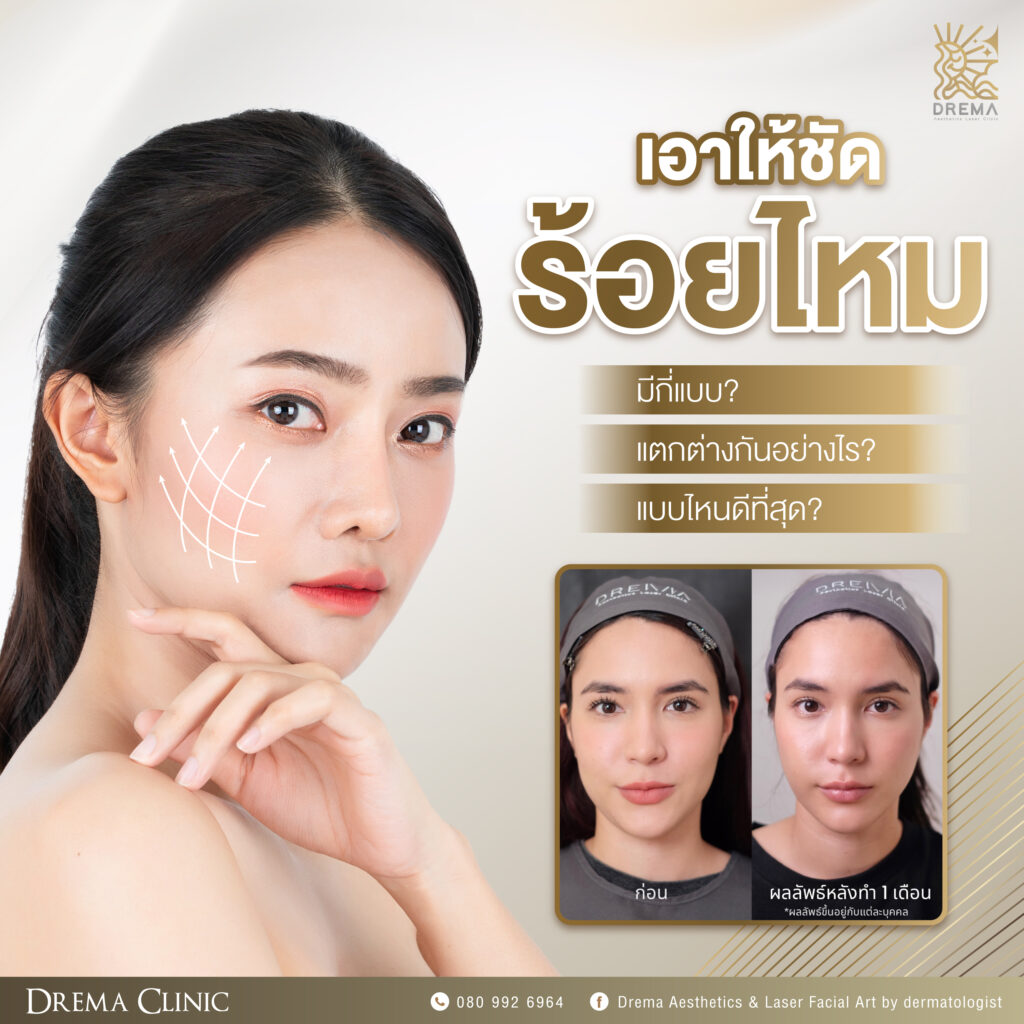 เอาให้ชัด ร้อยไหมมีกี่แบบ แตกต่างกันอย่างไร แบบไหนดีที่สุด