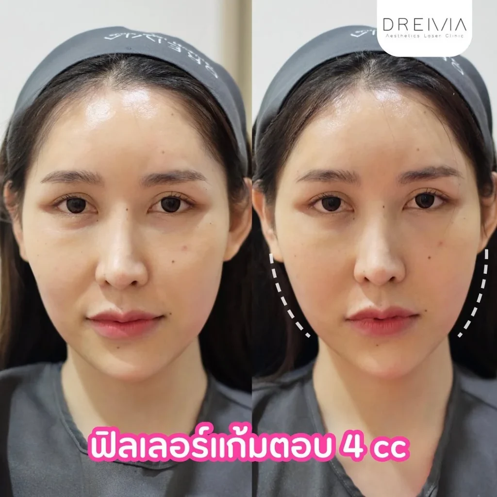 ฟิตเลอร์แก้มตอบ 4cc