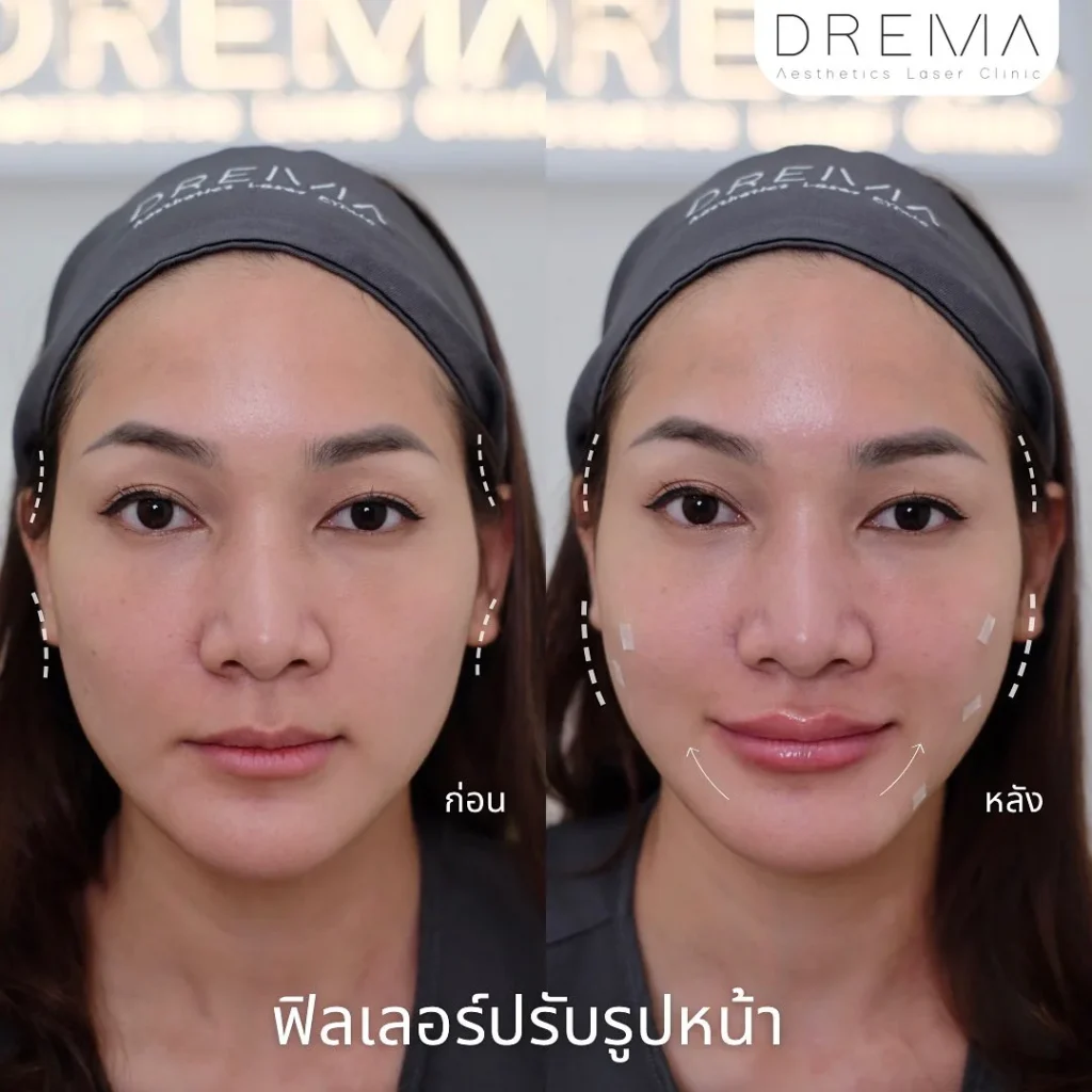 ฟิตเลอร์รับรูปหน้า